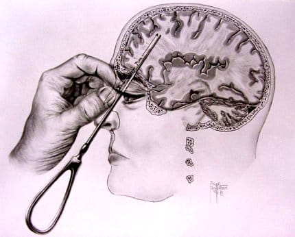 When Faces Made the Case for Lobotomy | NIH Record